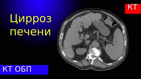 Биопсия печени: диагностика цирроза