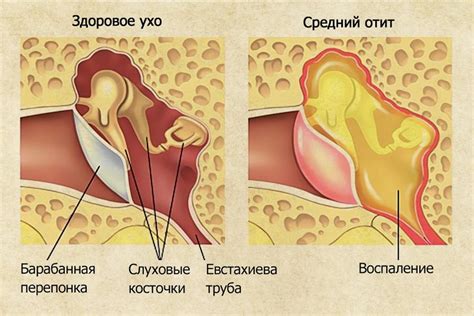 Боль и дискомфорт в ухе при простуде