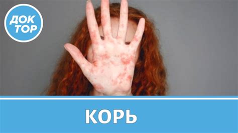 Взрослые и корь: пояснение