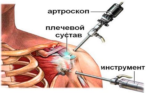 Виды повреждений связок плеча