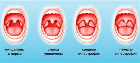 Воздействие на шейный хребет и горло ребенка: причины и способы устранения хрипов в бронхах