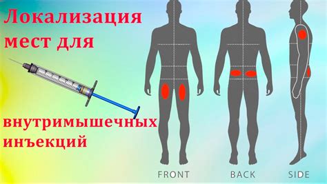 Выбор места для инъекции