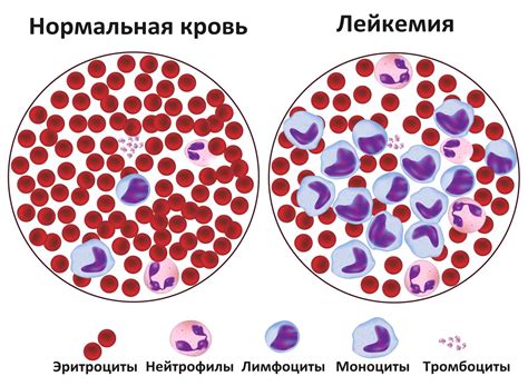 Диагностика лейкемии