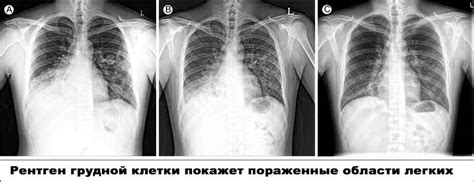 Диагностика пневмонии у взрослых