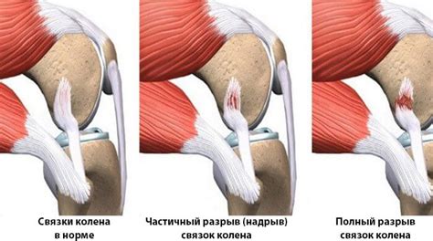 Диагностика порванной связки