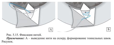 Завершающая фиксация нити