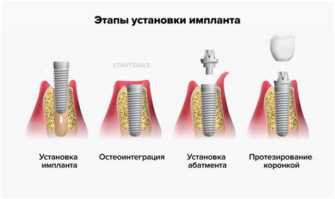 Закрепление и фиксация