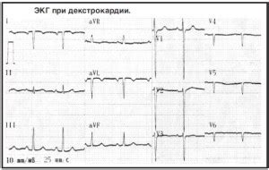 Зачем нужна ЭКГ при декстрокардии?