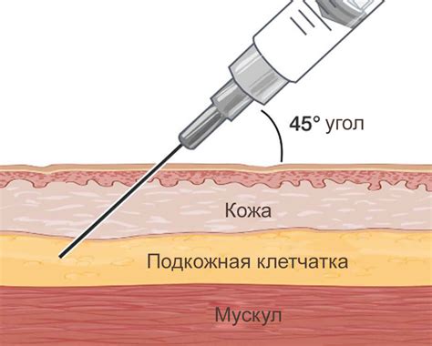 Как делать инъекцию мильгаммы правильно