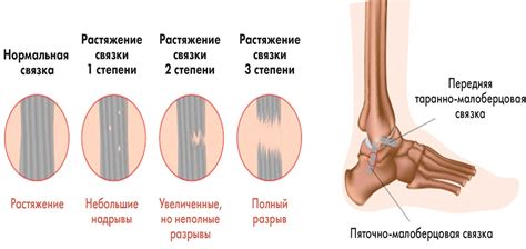 Как предотвратить растяжение или разрыв проколов?