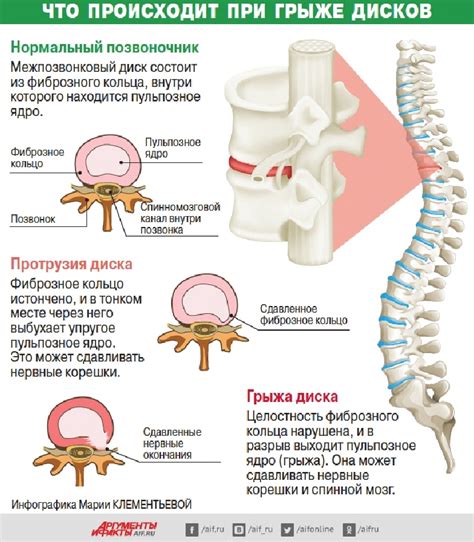 Как распознать грыжу - признаки и обследование