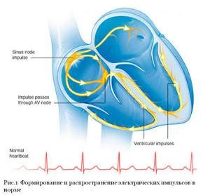 Кардиоверсия при мерцательной аритмии: эффективность лечения