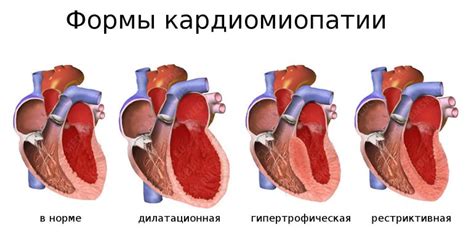 Лечение дилатационной кардиомиопатии