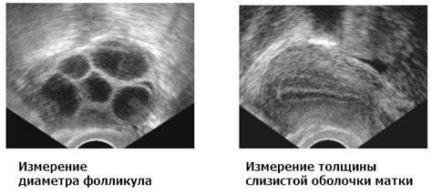 Медицинские методы определения количества фолликулов в яичниках у женщин