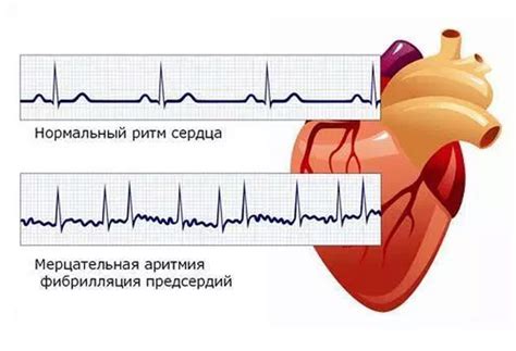 Мерцательная аритмия: причины и виды