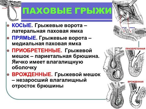 Методы консервативного лечения паховой грыжи у мужчин