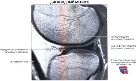 На что обратить внимание при обследовании мениска коленного сустава