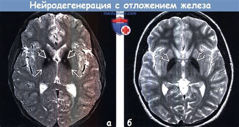 Нейрохимические изменения в мозге