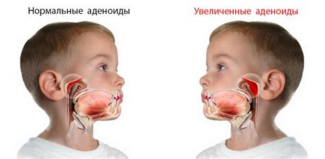 Оперативные методы удаления аденоидов в носу