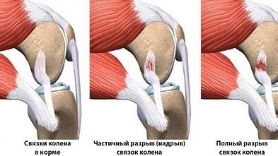 Операция по восстановлению связок в колене