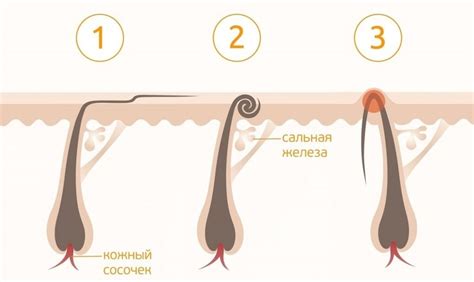 Основные признаки вросших волос