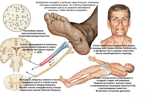 Основные симптомы столбняка у человека