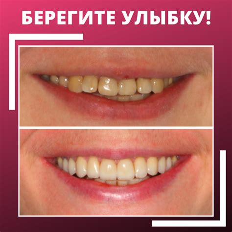 Отзывы пользователей о винирах Sow Smile