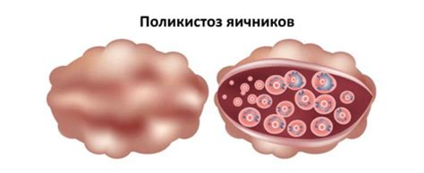 Патологии яичников