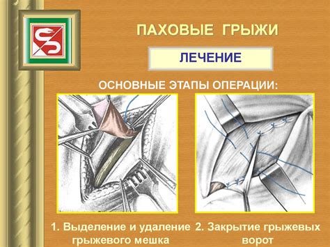 Паховая грыжа у женщин: подробности