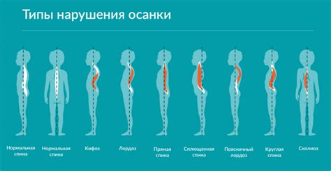 Плохая осанка и неправильное положение тела