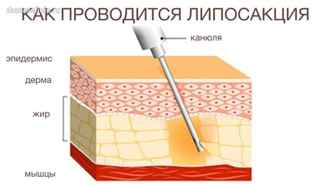 Подходящие условия для длительного сохранения результатов удаления каре