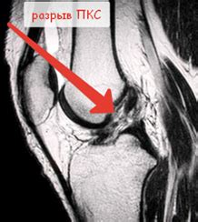 Полный разрыв связки
