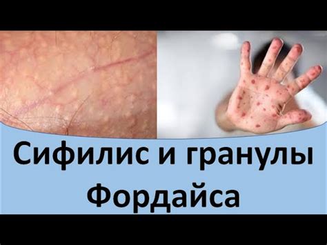 Популярные методы удаления гранул Фордайса