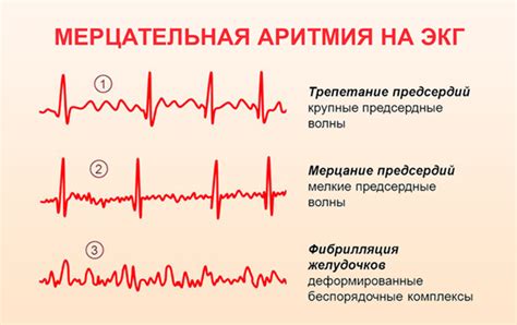 Последствия мерцательной аритмии