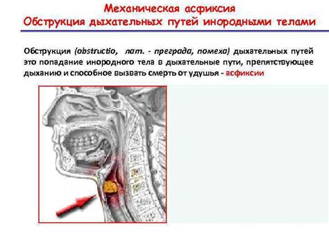 Почему возникает обструкция дыхательных путей?