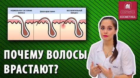 Почему волосы врастают после шугаринга