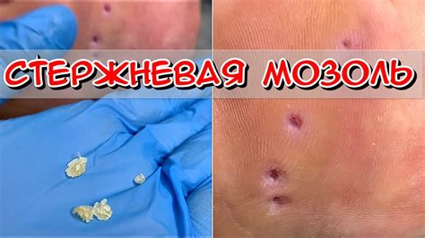 Почему нужно доверить профессионалам удаление мозоли