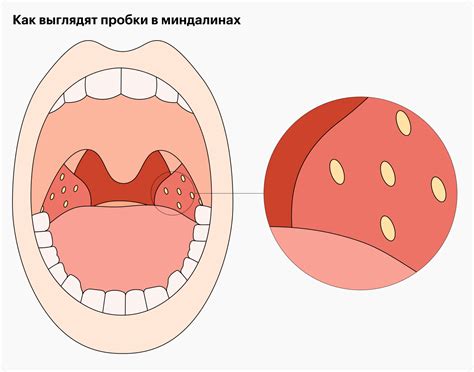 Почему образуются пробки в миндалинах?