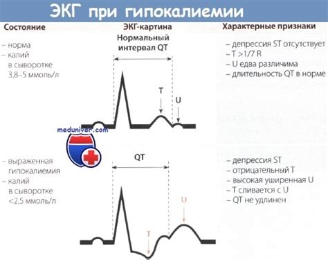 Признаки проблем с ЭКГ, требующие первой помощи