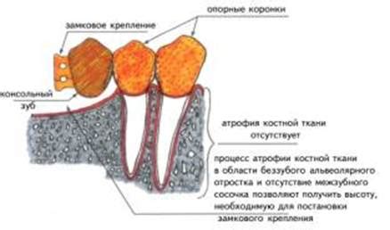 Применение замковых отмычек