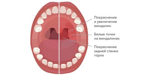 Причины запаха миндалин