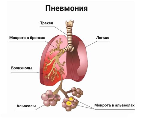 Причины пневмонии у взрослых