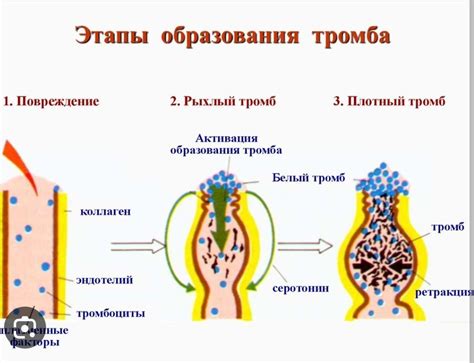 Промежуточная фаза образования тромба