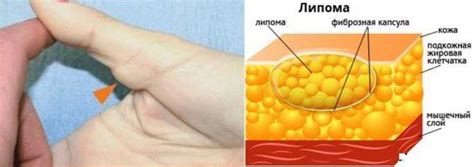 Профилактика жировика