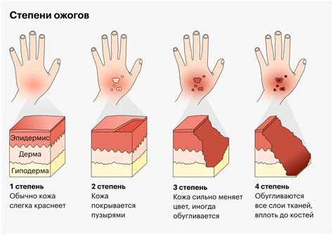 Профилактика ожогов в домашних условиях