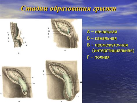 Процесс образования грыжи