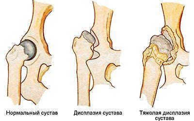 Симптомы вывихнутого таза у взрослых