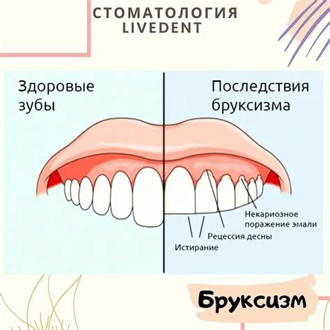 Симптомы и последствия бруксизма