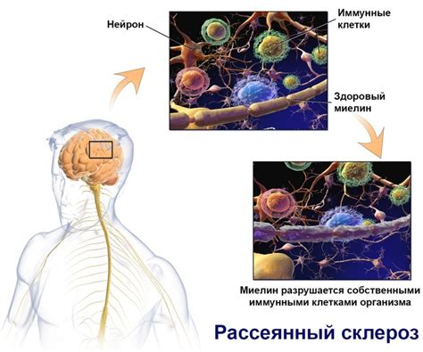 Симптомы миелиновой оболочки нерва