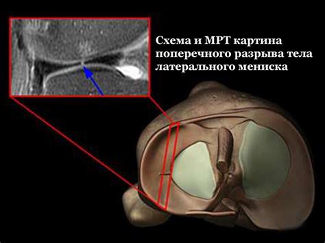 Современные методы диагностики повреждения мениска